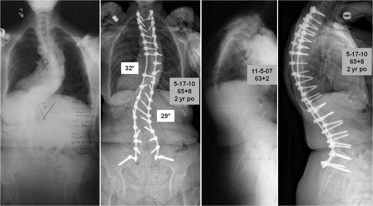 scoliosis Adult in
